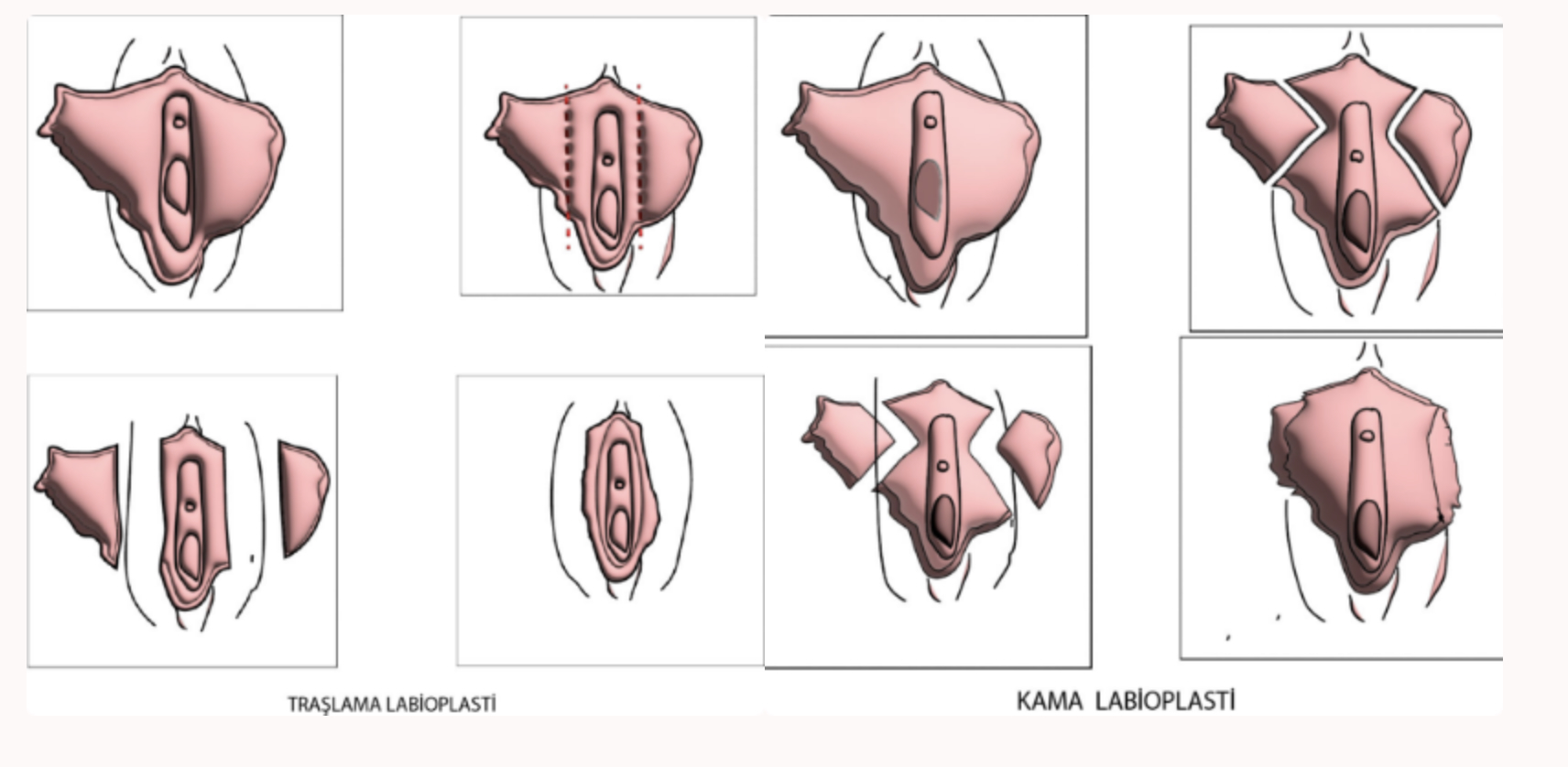 Vajinal İç Dudak Estetiği (Labioplasti) Nedir? Kimler İçin Uygundur?